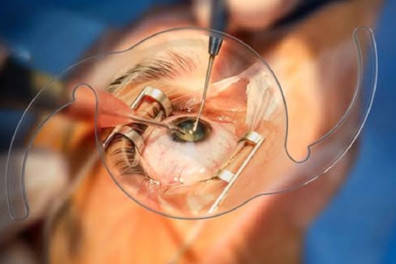 Cataract Surgery